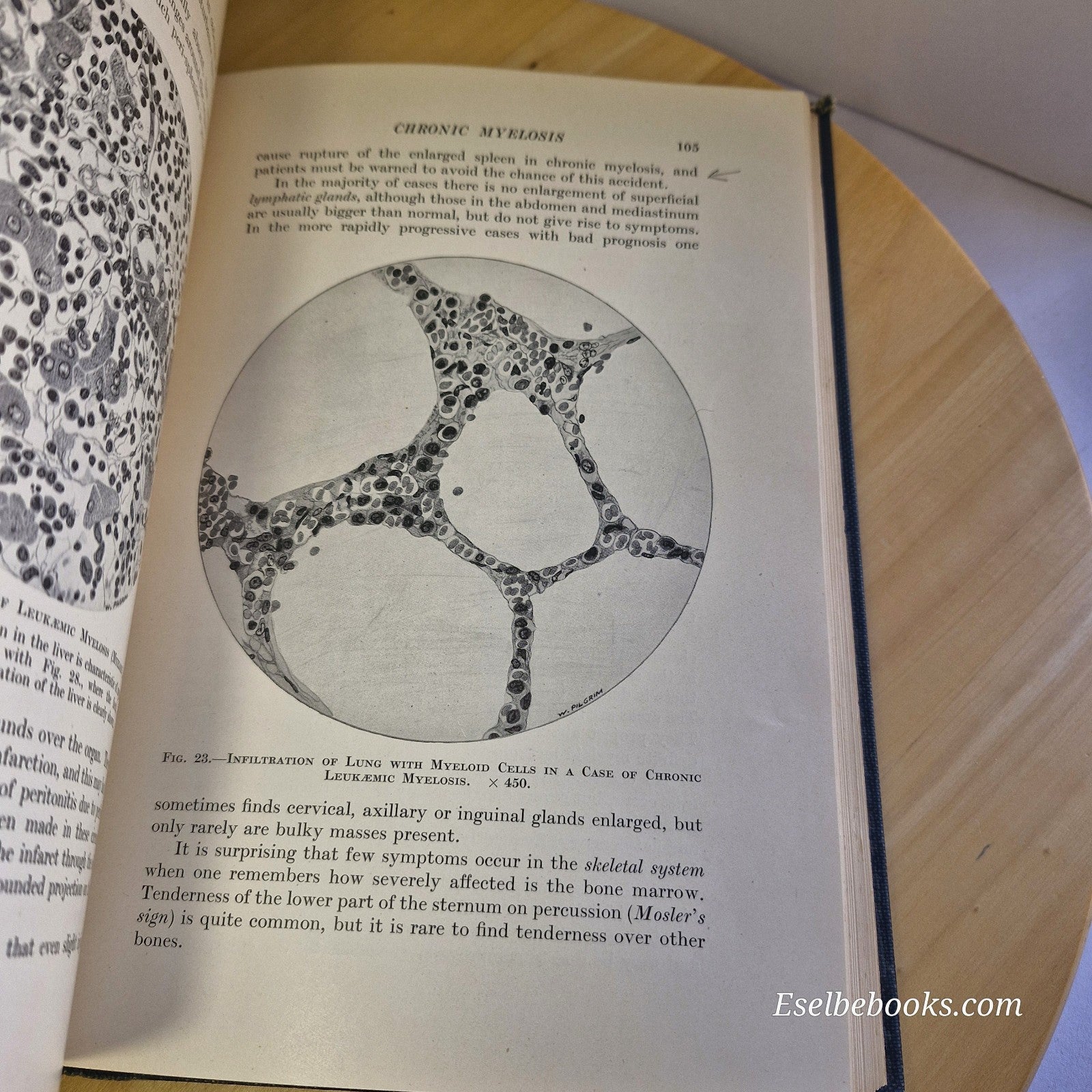 Diseases of the Blood 2nd edition By Alfred Piney - vintage hardback