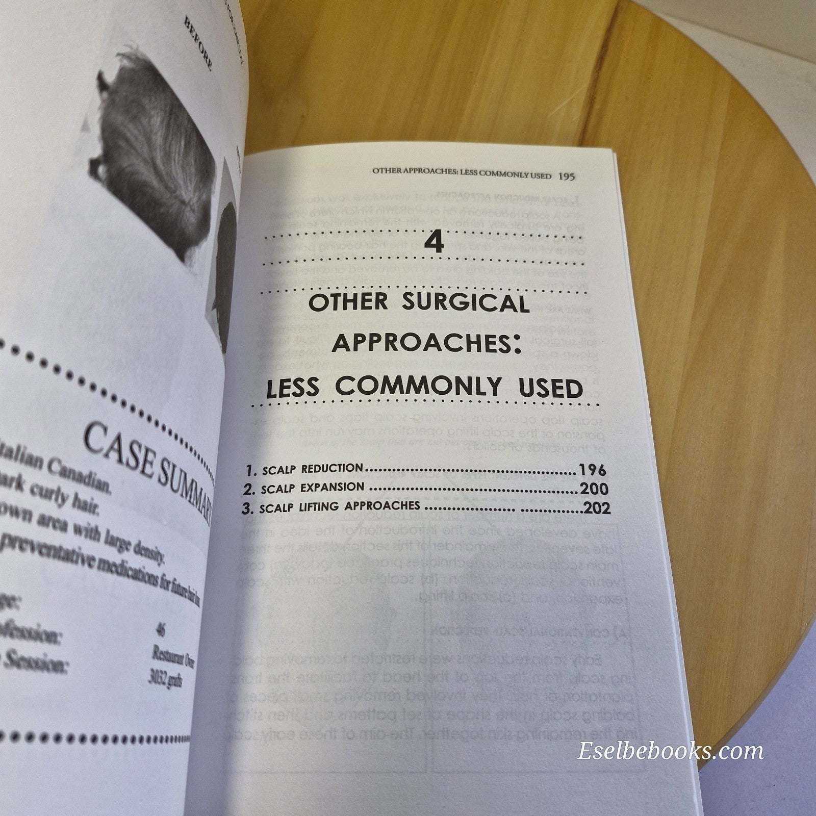 3 books about hair loss/alopecia - hardback/paperbacks