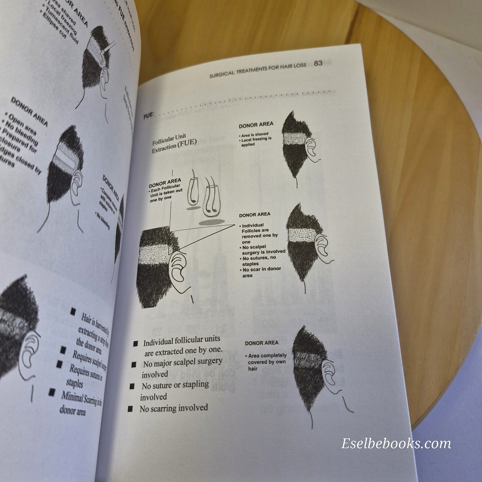 3 books about hair loss/alopecia - hardback/paperbacks